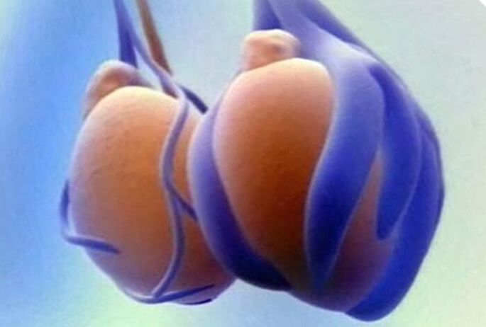 Варикоцеле